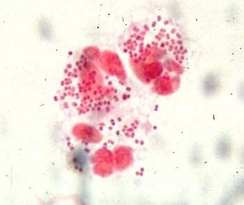 淋球菌镜下形态图片