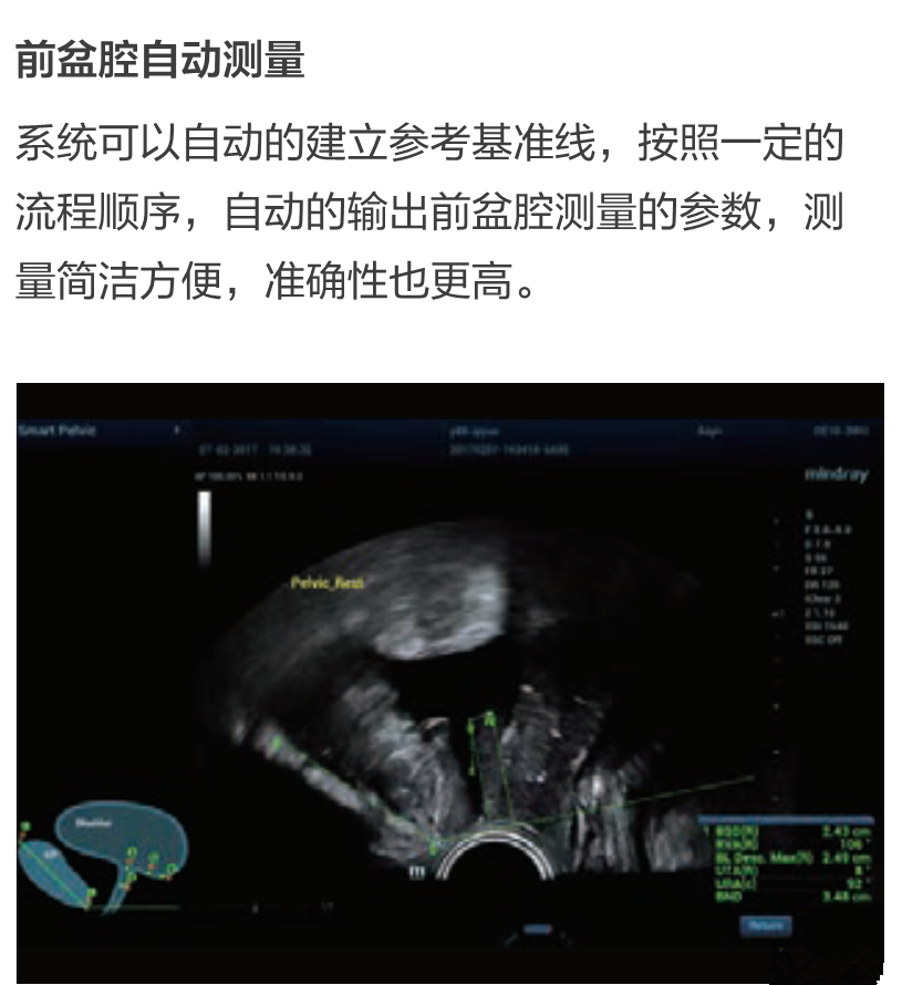 resona7怎么样国产昆仑高端系列超声迈瑞彩超Resona 6T_https://www.jmylbn.com_新闻资讯_第1张